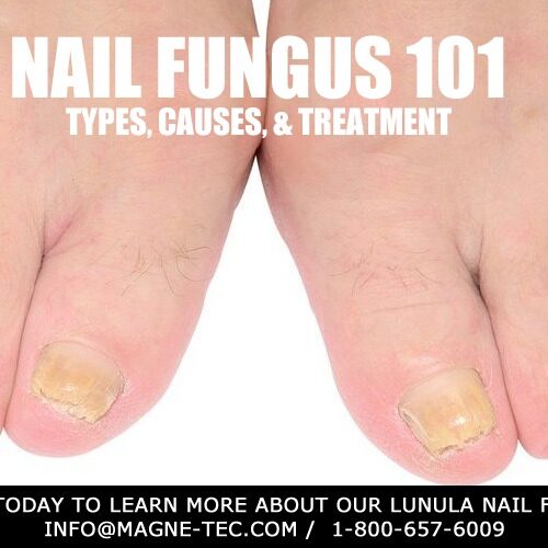 Nail-Fungus-101-MagneTec-Post